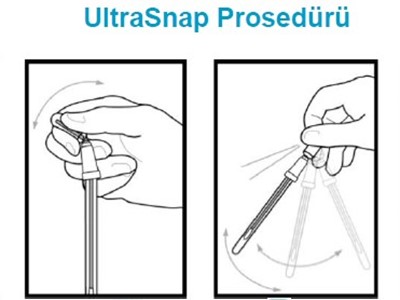 UltraSnap Prosedürü